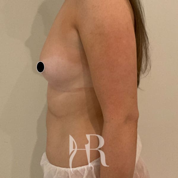 HR Plastic Surgery - Breast Enlargement patient before 15